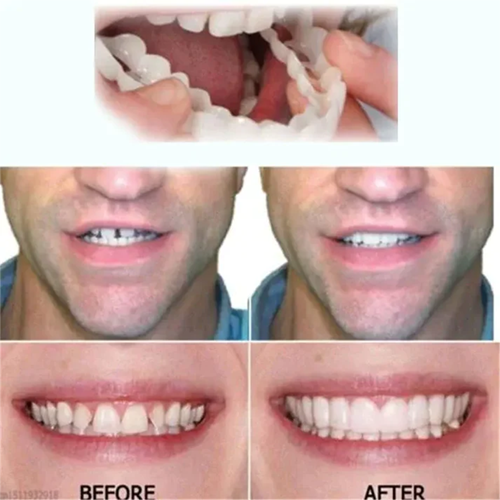 Cosmetische Tandveneers met Aanpasbare Pasvorm Herbruikbaar voor Natuurlijke Witte Glimlach Tandcorrectie