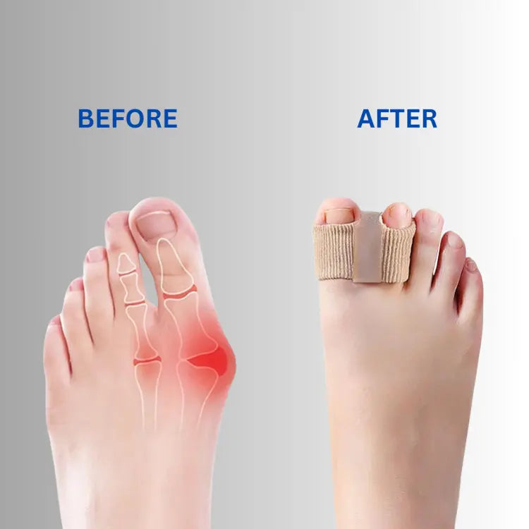 Teenspreiderset Siliconen voor Hallux Valgus en Overlappende Tenen - Zachte Correctie & Pijnverlichting