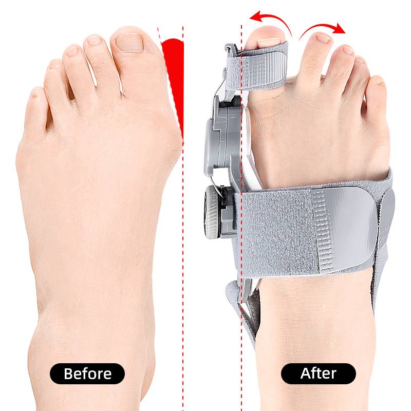 Teencorrector met Verstelbare Druk voor Hallux Valgus Behandeling Overdag en 's Nachts Comfortabel Orthopedisch