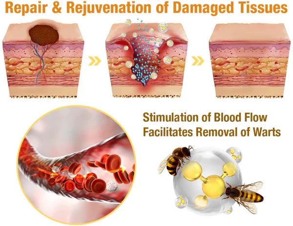 Bijengifsray voor Huidgroei - Natuurlijke Verwijdering van Huidlappen, Wratten en Moedervlekken